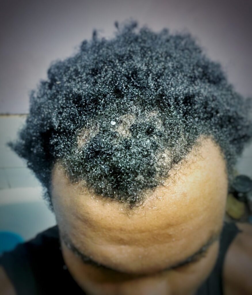 traction alopecia thinning hairline from tight hairstyles
