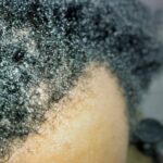 can dreadlocks cause thinning hair specialist assessment