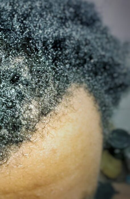 can dreadlocks cause thinning hair specialist assessment