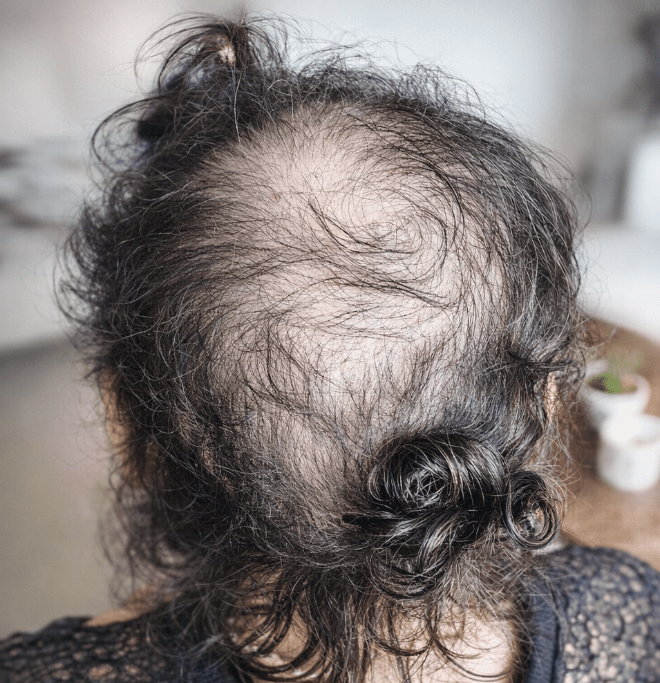 specialist dreadlock assessment for thinning hair and fragile roots