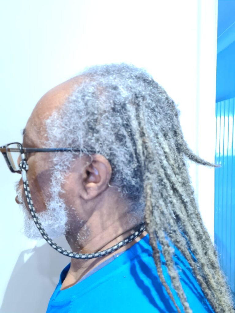 fragile-root-dreadlocks-before-specialist-assessment.3jpg