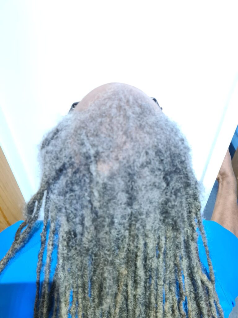 fragile-root-dreadlocks-before-specialist-assessment.jpg