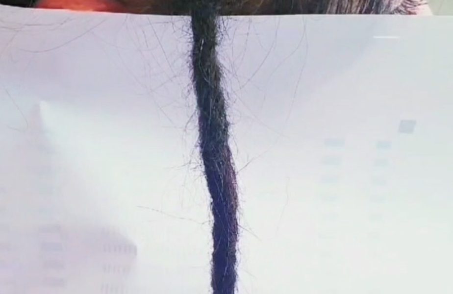 alopecia-dreadlock-design-result A finished result showing carefully planned coverage, preferably from the side or back.
