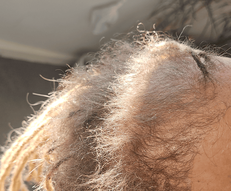 Front and temple hair before a specialist dreadlock assessment