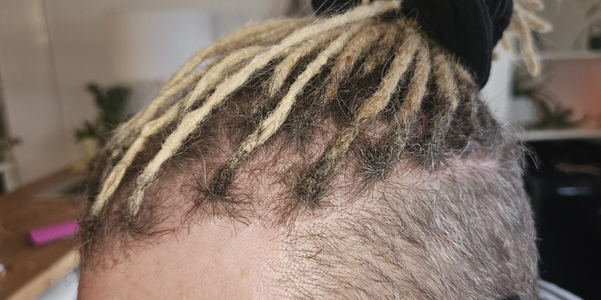 Permanent dreadlock extensions framing the front of the hair