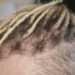 Permanent dreadlock extensions framing the front of the hair