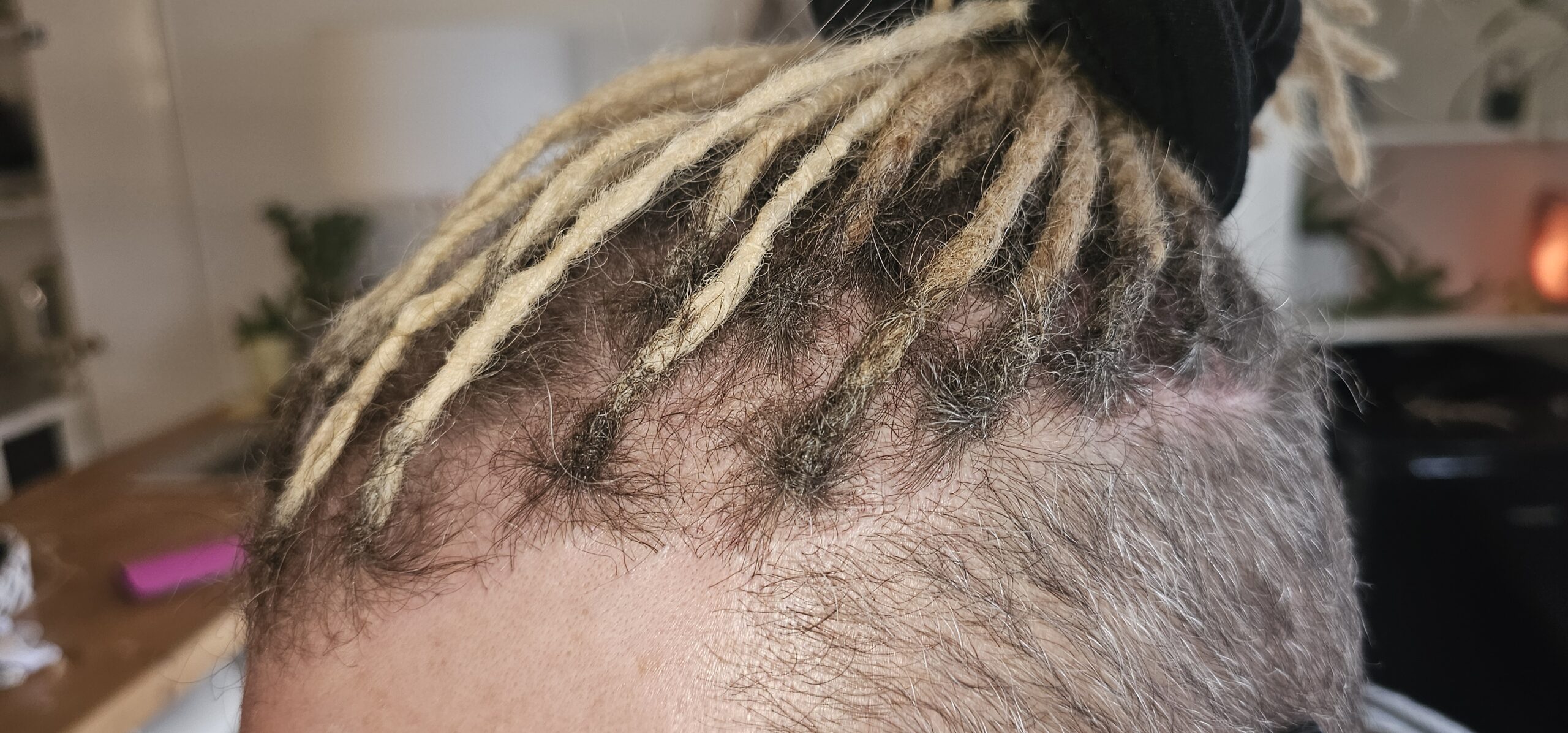 Permanent dreadlock extensions framing the front of the hair
