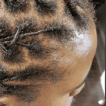 Existing dreadlock set showing the current hairline and root areas