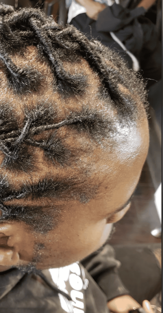 Existing dreadlock set showing the current hairline and root areas
