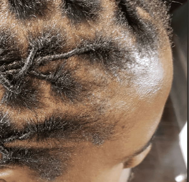 Existing dreadlock set showing the current hairline and root areas